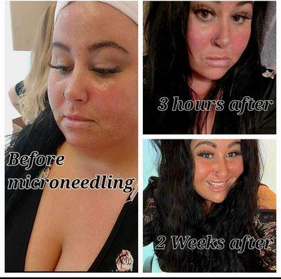 Microneedling before and after. Call now for more information at (859) 444-8353.