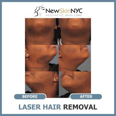 laser hair removal