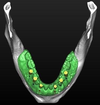 Implants By Paresh