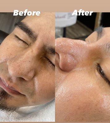 BLACKHEADS REMOVAL AVAILABLE!