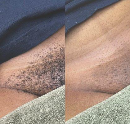 brazilian wax