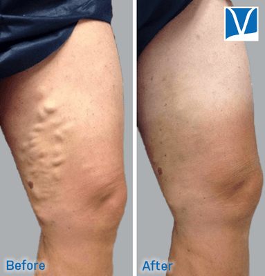 Before & after varicose vein treatment