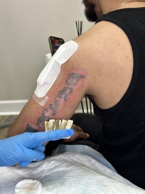 First session taking ink out of the body. Magnetic tattoo removal technique