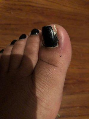 Swollen toe from ingrown toenail.