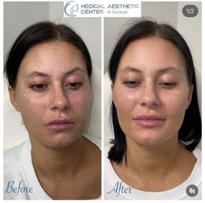 Full facial balancing with mid face, jaw, and chin filler to achieve the best looking you!