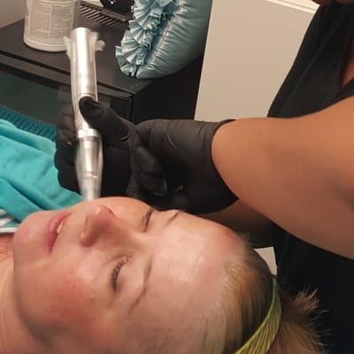 Collagen Induction Therapy aids in the reduction if fine lines,wrinkles,scarring and stretchmarks.