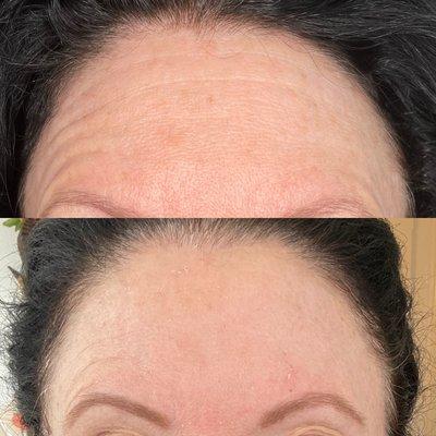 Before and 8 days after plasma skin tightening on the forehead.