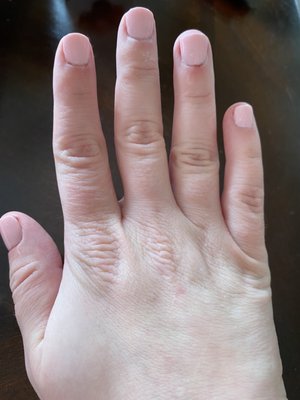 Swollen finger tips