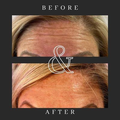 Before and after using Neurotoxins! Relax those muscles and prevent future wrinkles!