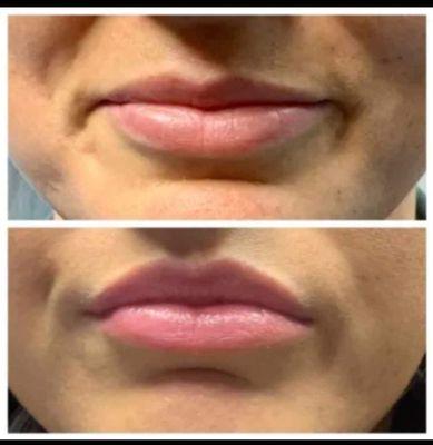 Lip fillers and lip flips available in Florence, KY. Call us at (859) 444-8353 for more information.