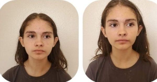 Before and after photo of teen acne facial