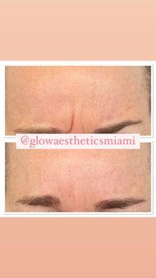 Botox treatment