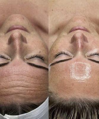 Are you looking a natural glow and rejuvenated skin? We can help with a Hydrofacial! Here is a Before and After.