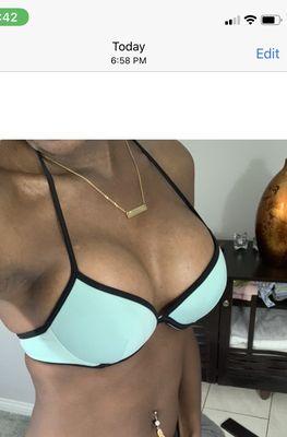 Breast augmentation