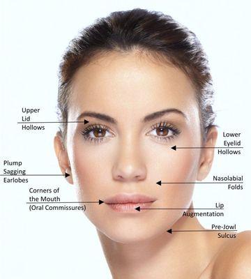 Diminish wrinkles with soft surgery that is quick healing from a surface only skin tightening technique.