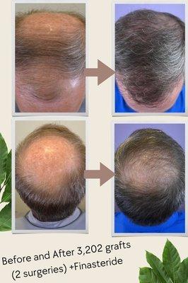 Before and after two hair transplant surgeries along with medical therapy for male pattern hair loss (Dr Nicole Rogers)