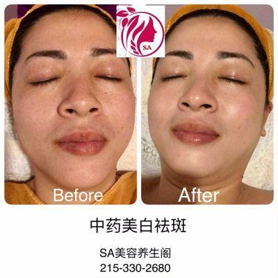 Chinese Herbal Freckle Treatment