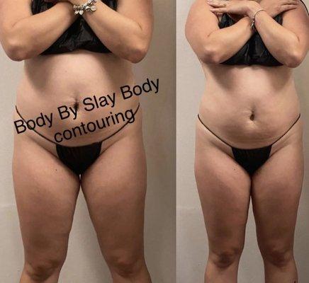 Body contouring