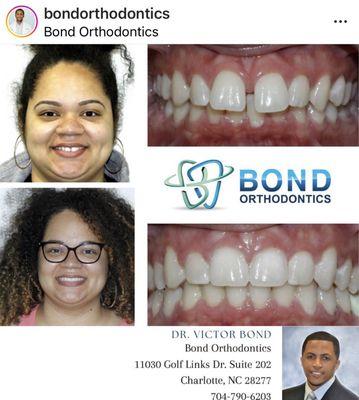 Bond Orthodontics