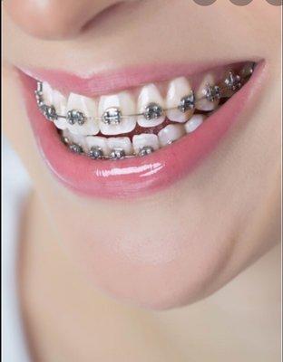 Traditional Braces