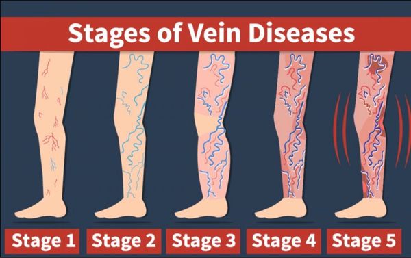 Vein disease can get worse if not treated!