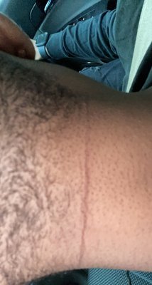 Long cut along my neck