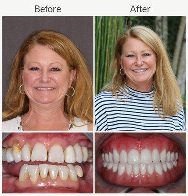 Lynn  received our FOY® Dentures on the upper and lower teeth.