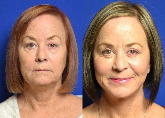 Facelift Procedure - Before & After.