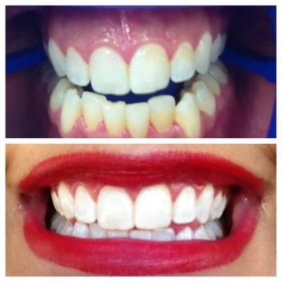 before & after: 1 hour in office whitening