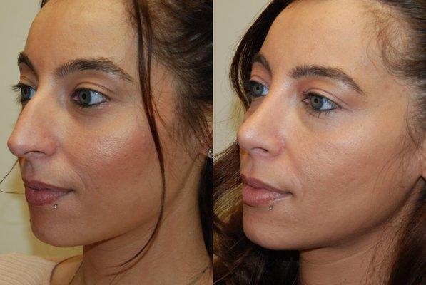 Beyond satisfied! Rhinoplasty surgery