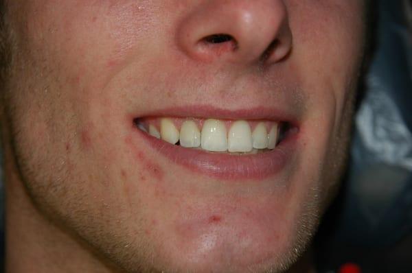 Fixed broken tooth with extraction, implant and crown.