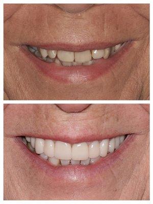 Invisalign plus Porcelain Crowns