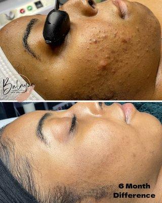 Before and after of clearance of grade 3 acne!