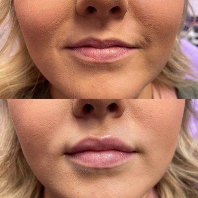 Lip Filler