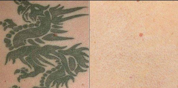 Before and after laser tattoo removal.