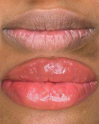 Lip Neutralization for Melanin Rich Lips