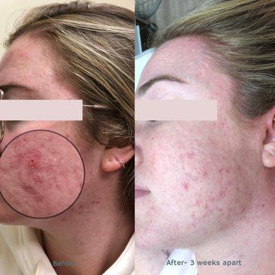 Acne Specialist- Client 3 weeks apart