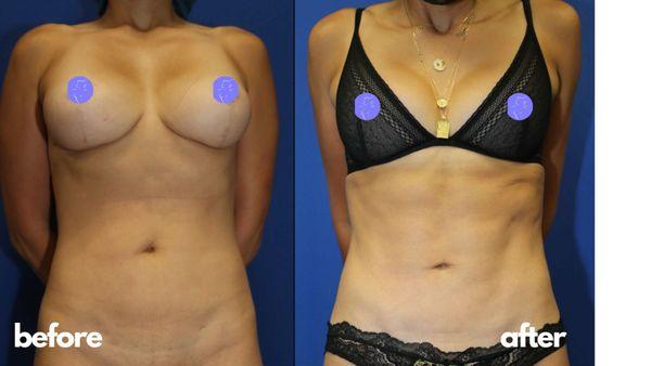 Vaser Hi-Def Liposuction on 32 y/o female patient