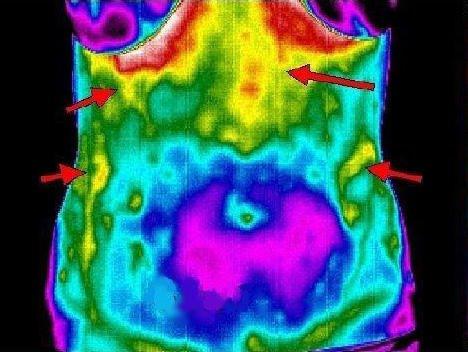 Detecting gastroesophageal reflux disease (GERD) with thermography not radiation