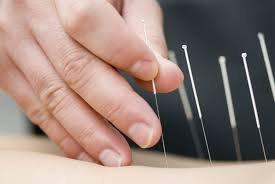 Acupuncture Services