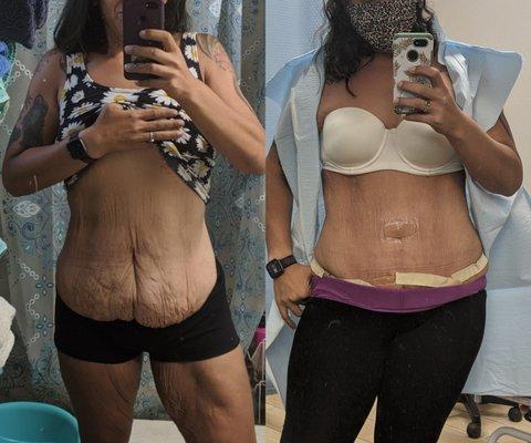 Tummy tuck