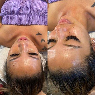 Chemical peel