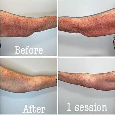 Cryoskin results after 1 treatment on arms