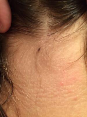 A lice bug at the base of my daughters hair line.  Visited The Lice Place in Katy to make certain no more eggs or bugs.