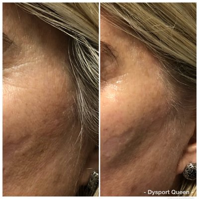 Subtle cheek enhancement using Restylane