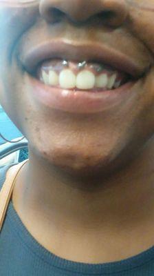 Smiley piercing