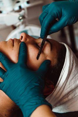 Dermaplane exfoliation