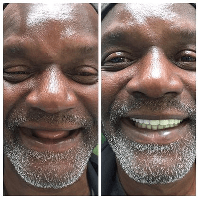 Before and After at NÜVA Smile | Bergenfield, NJ