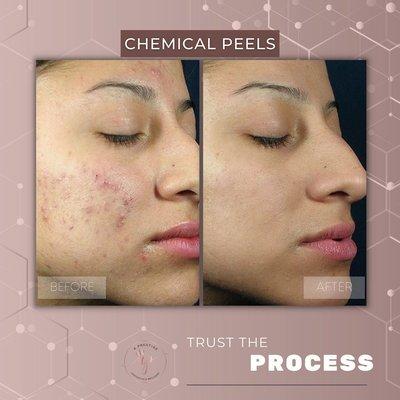 Chemical peels