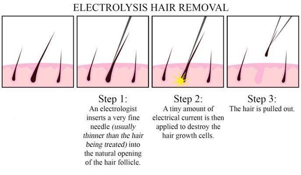 This is how electrolysis works.